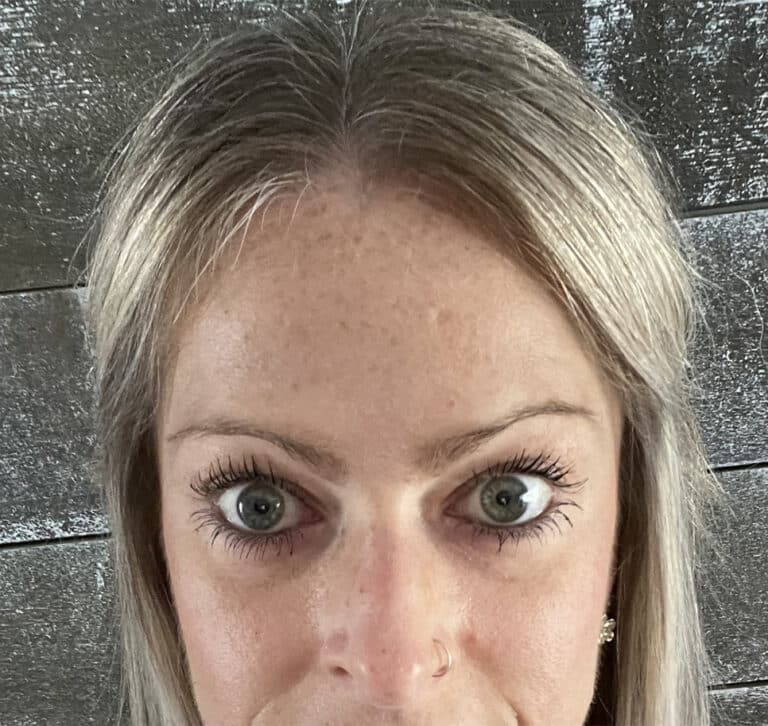 After Image: Botox - front