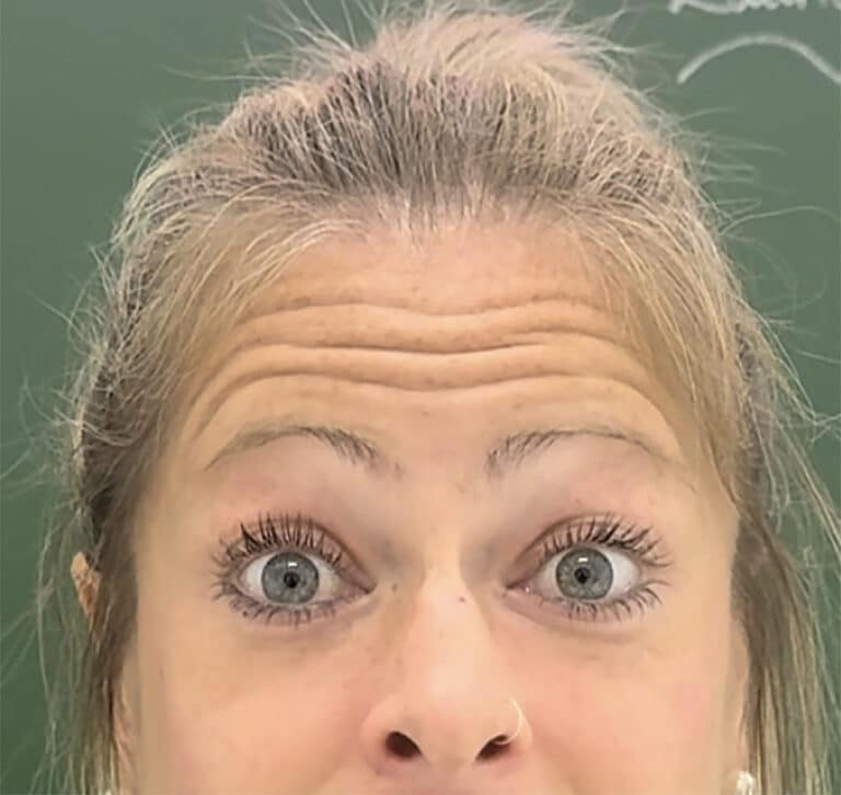 Before Image: Botox - front