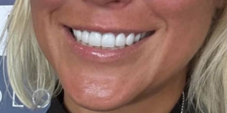 Before Image: Botox Lip Flip - front