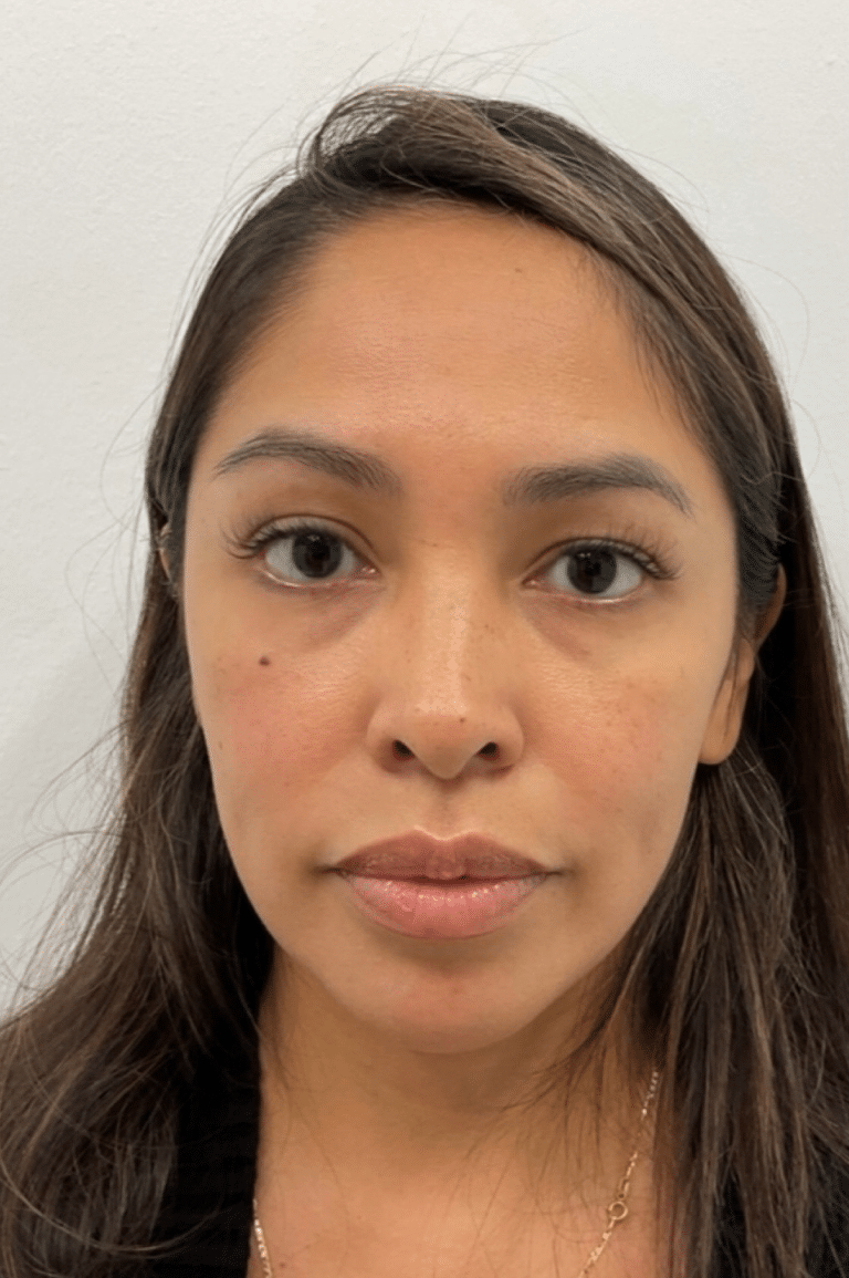 Before Image: Dermal Filler - front