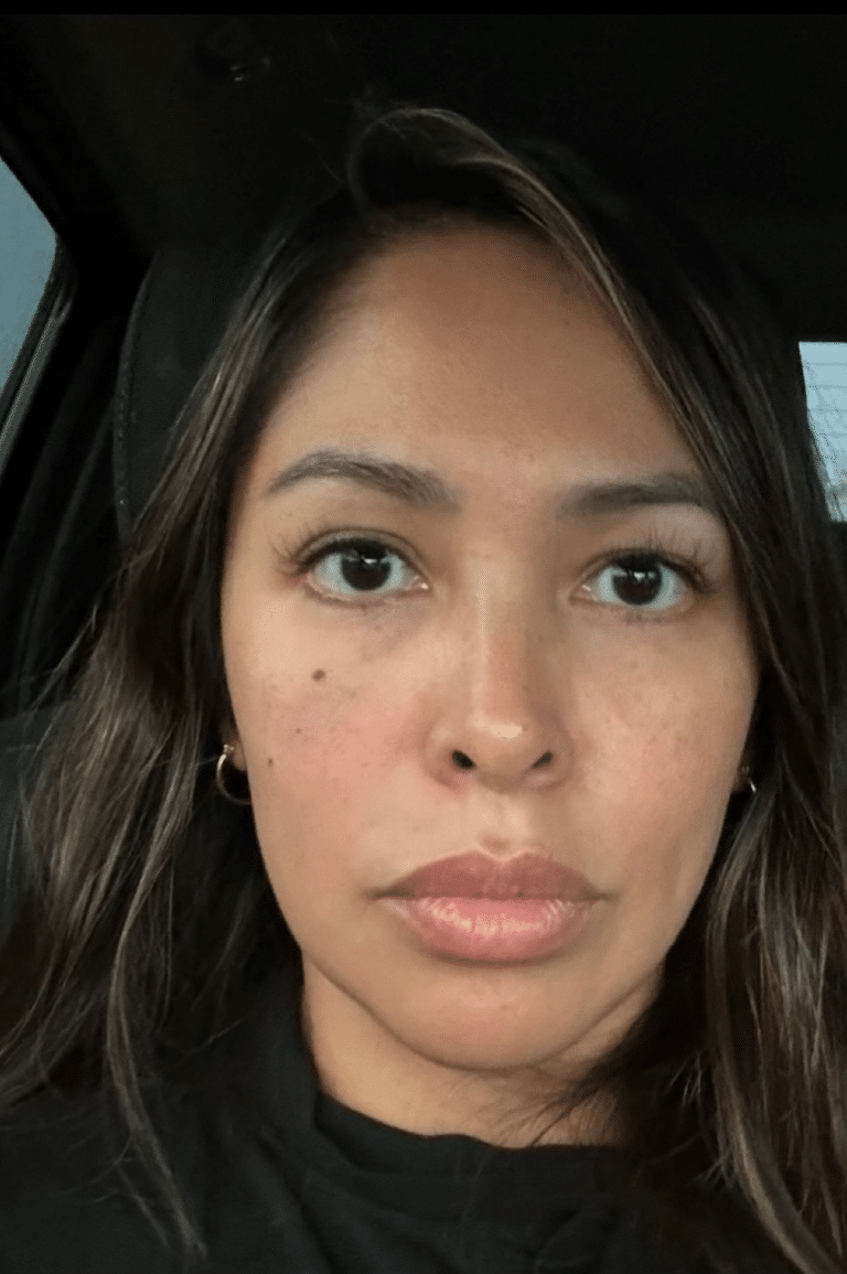 After Image: Dermal Filler - front