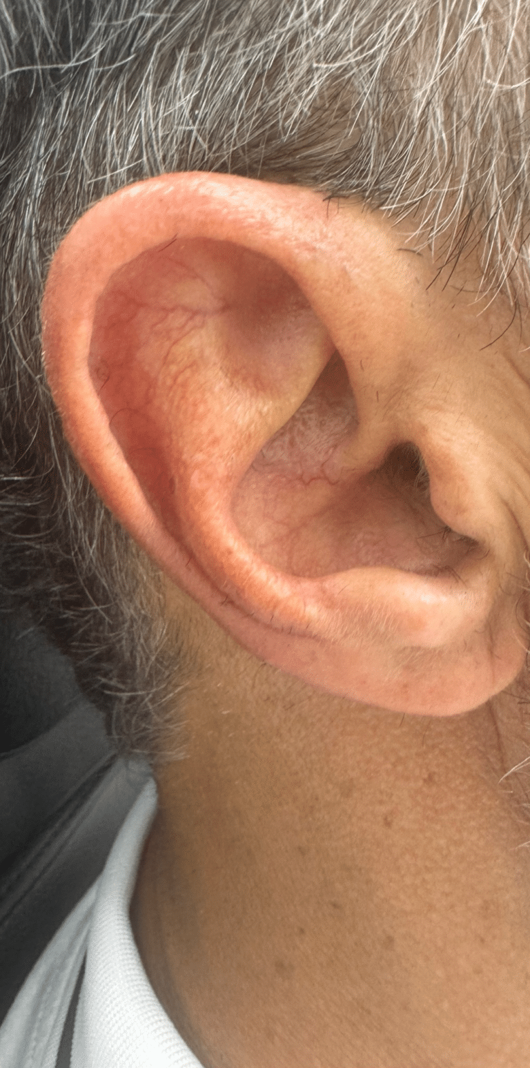 Before Image: Vascular Laser Long Pulsed YAG - right-side