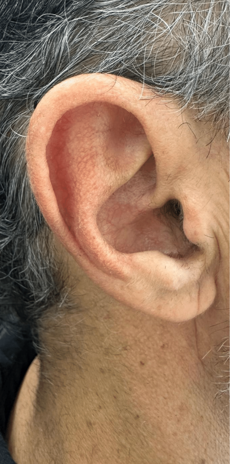 After Image: Vascular Laser Long Pulsed YAG - right-side