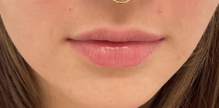 Before Image: Lip Filler - front