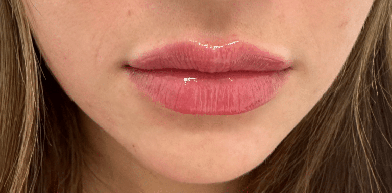 After Image: Lip Filler - front