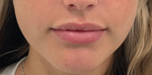 Before Image: Dermal Filler