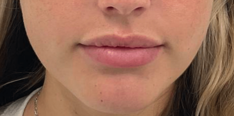 Before Image: Dermal Filler - front