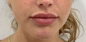 After Image: Dermal Filler
