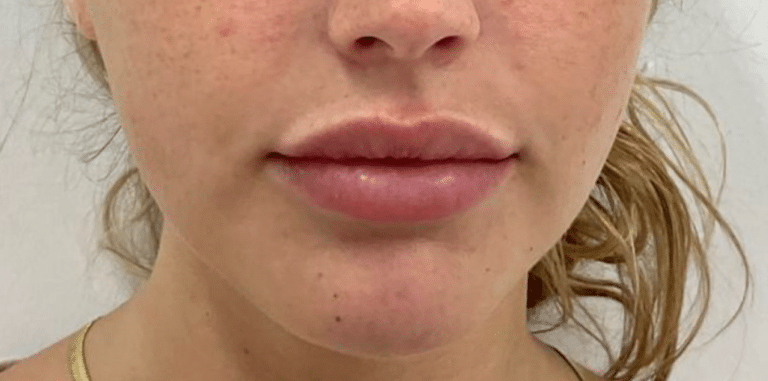 After Image: Dermal Filler - front