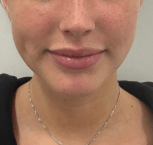 Before Image: Dermal Filler