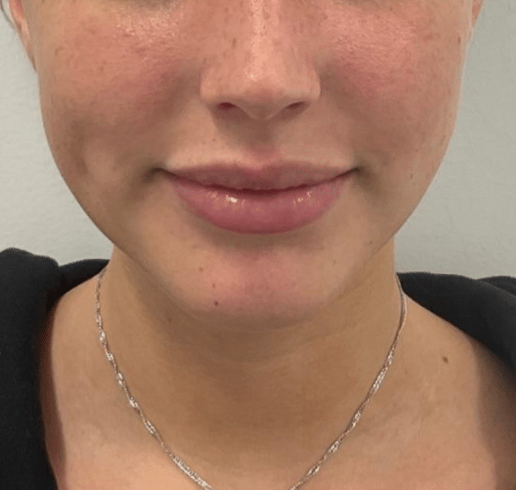 Before Image: Dermal Filler - front