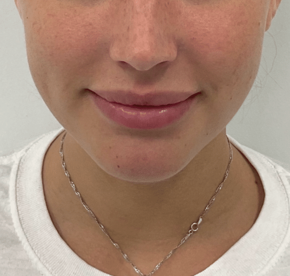 After Image: Dermal Filler - front