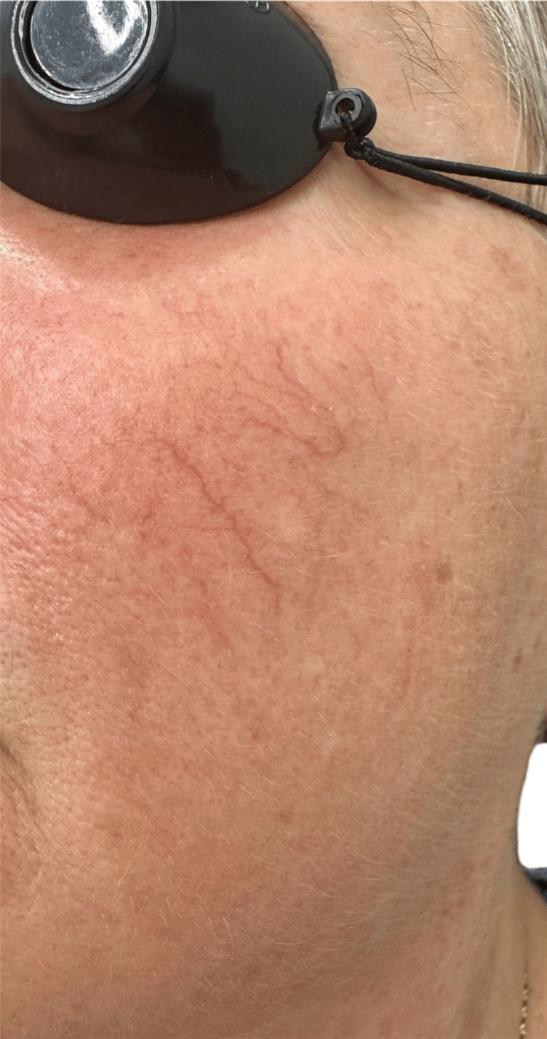 Before Image: Vascular Laser Long Pulsed YAG - left-side