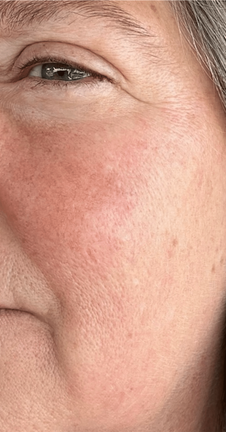 After Image: Vascular Laser Long Pulsed YAG - left-side