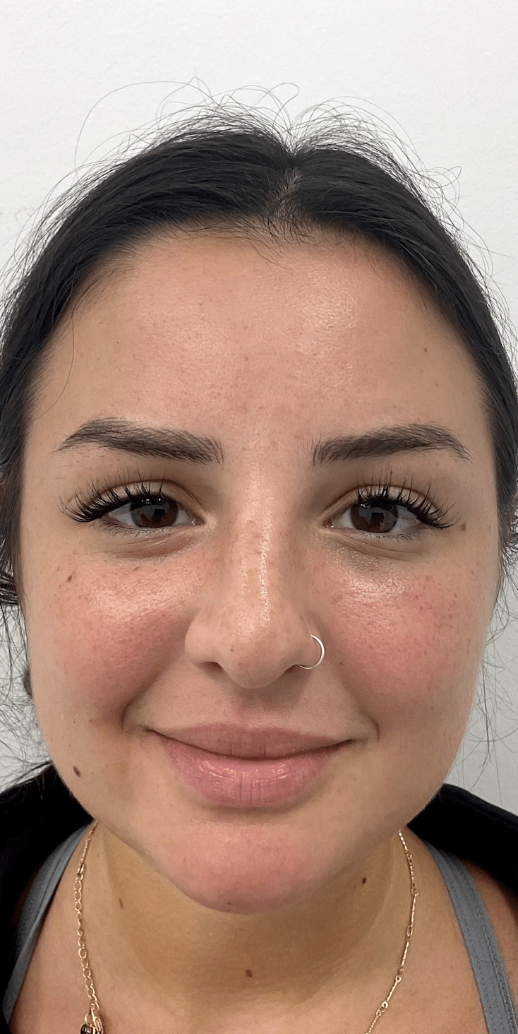 After Image: Botox - front