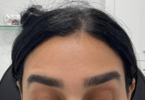 After Image: Botox