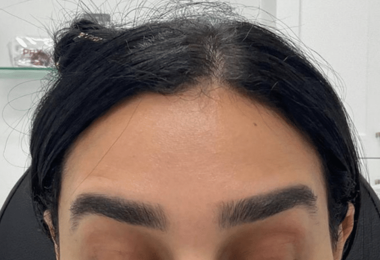 After Image: Botox - front