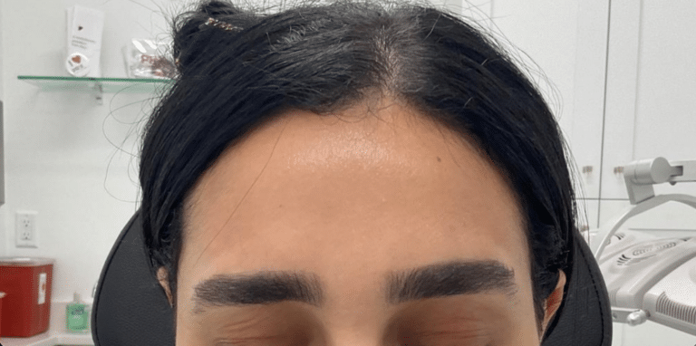 After Image: Botox - front