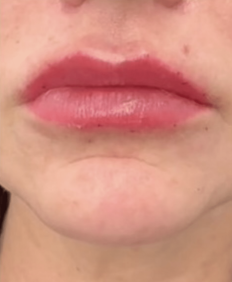 After Image: Lip Filler - front