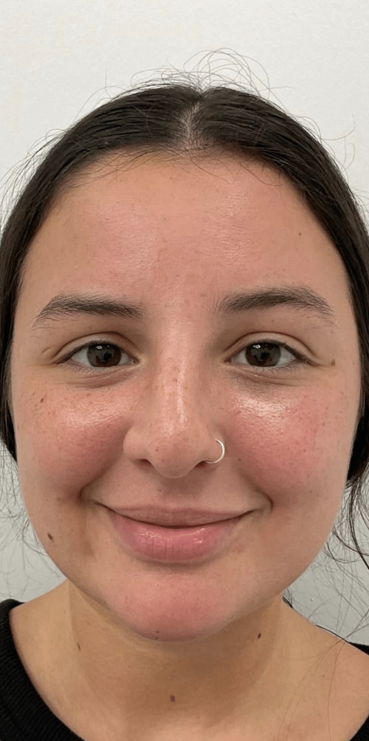 Before Image: Botox - front