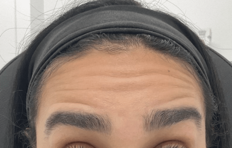 Before Image: Botox - front