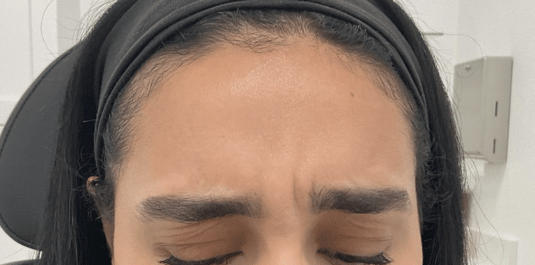 Before Image: Botox - front