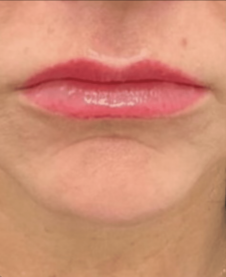 Before Image: Lip Filler - front
