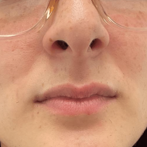 Before Image: 2 Syringes Filler -