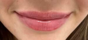 After Image: Lip Filler