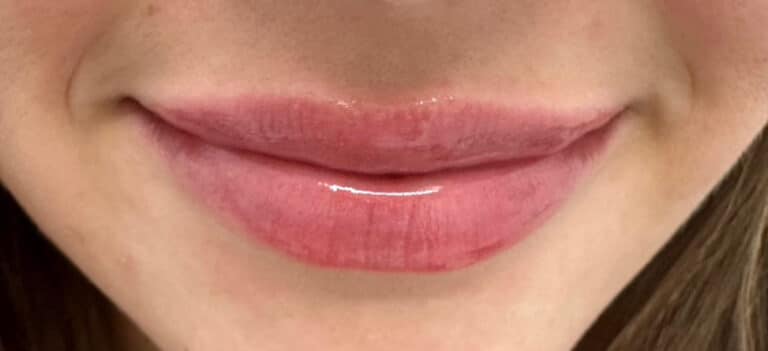 After Image: Lip Filler - front
