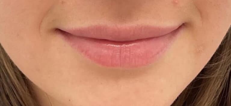 Before Image: Lip Filler - front