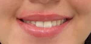 After Image: Lip Filler