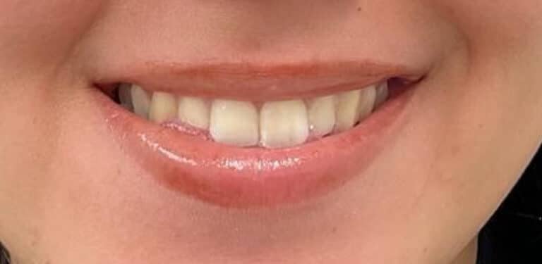 Before Image: Lip Filler - front