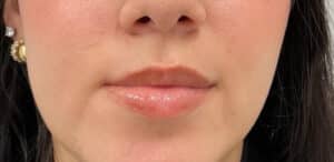 Before Image: Lip Filler