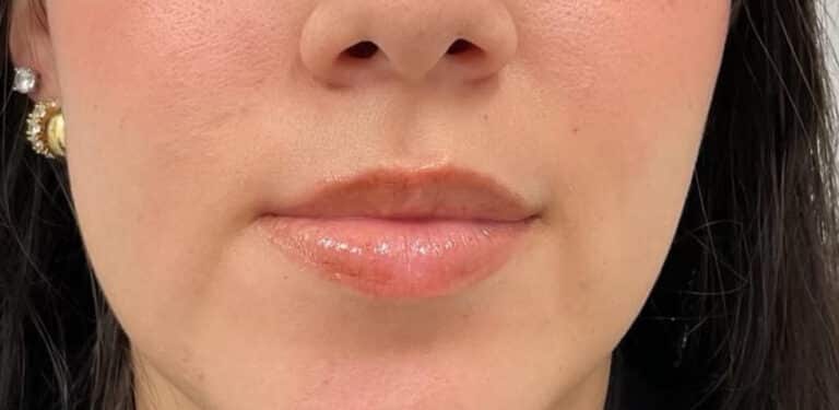 Before Image: Lip Filler - front