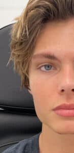 After Image: Masseter Botox