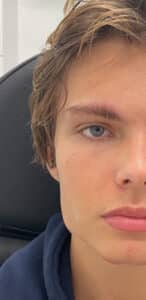 Before Image: Masseter Botox