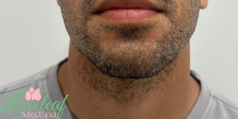 After Image: Dermal Filler - front