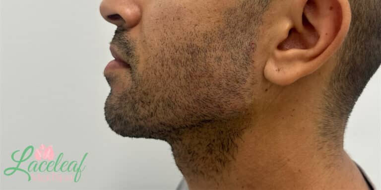 After Image: Dermal Filler - left-side