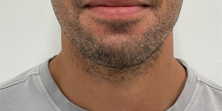 Before Image: Dermal Filler - front