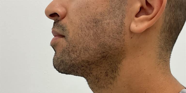Before Image: Dermal Filler - left-side