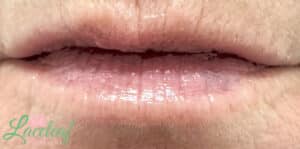 After Image: Vascular Laser Long Pulsed YAG