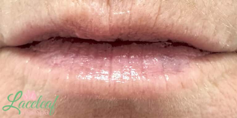 After Image: Vascular Laser Long Pulsed YAG - front