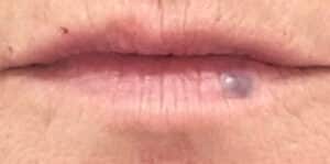 Before Image: Vascular Laser Long Pulsed YAG