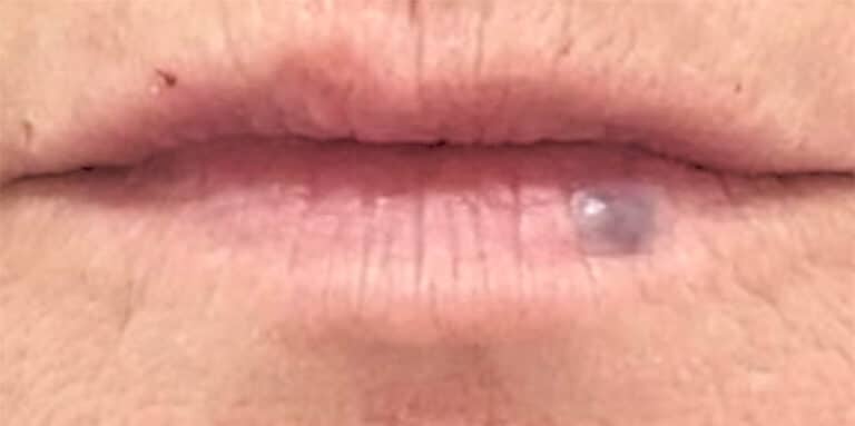 Before Image: Vascular Laser Long Pulsed YAG - front
