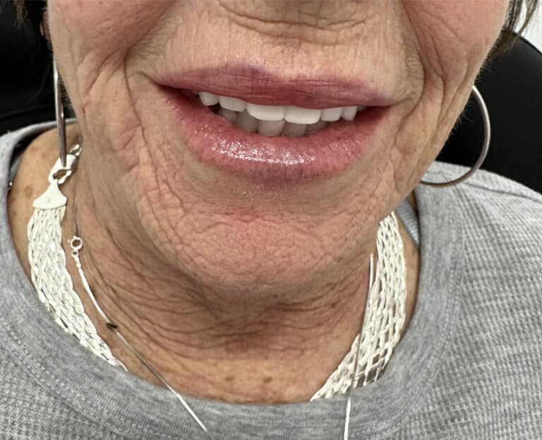 After Image: Lip Filler - front