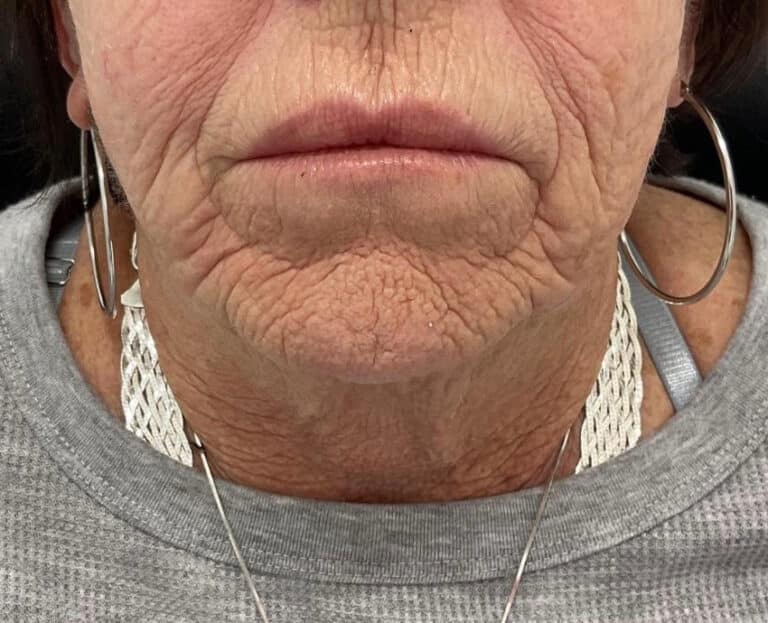 Before Image: Lip Filler - front