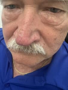 After Image: Vascular Laser Long Pulsed Yag