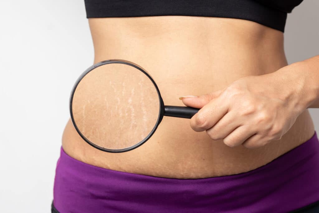 RF Microneedling on stretch marks